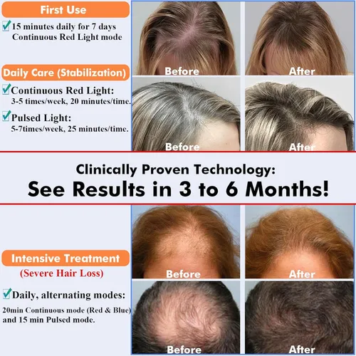 Vista 5 de LLLT - Gorra de crecimiento láser para el crecimiento del cabello, terapia de luz roja y azul para el crecimiento del cabello y gestión de pérdidas