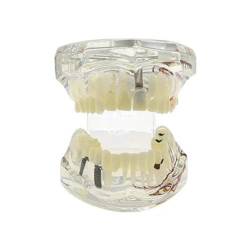 Vista 6 de Multifarious Tipos Modelo Dental Dientes Removibles Implante Ortodoncia Enseñanza Estudiar Modelos de demostración para Dentista Estudiante Escuela
